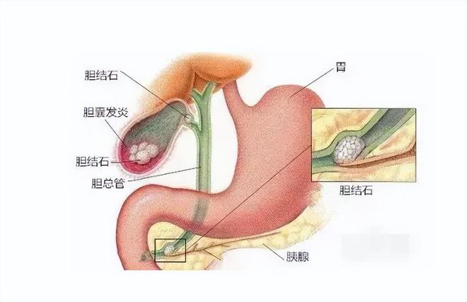 女子膽囊內(nèi)驚現(xiàn)超400顆結(jié)石